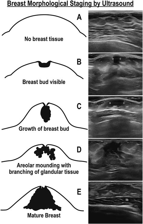 big boob teenagers|Breast development: Stages and how to spot growth signs .